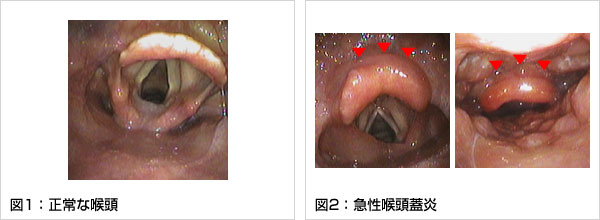 男性の咽頭クラミジア治療 - 症状や治し方 |