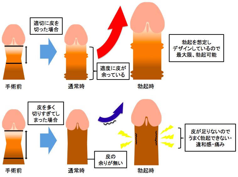 包茎・治療 | セントラルクリニック（大阪難波・神戸元町・周南市徳山・滋賀草津・三重県津院）