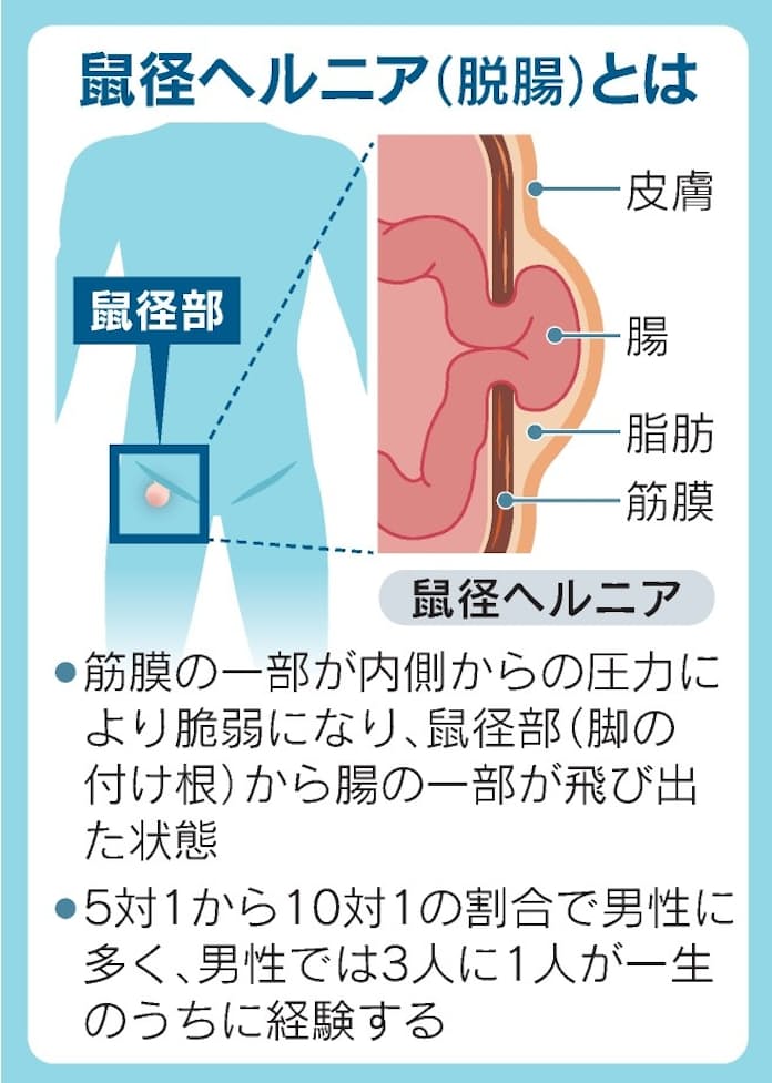 鼠径ヘルニアの治療 | 鼠径ヘルニア日帰り外科広島アルプスクリニック