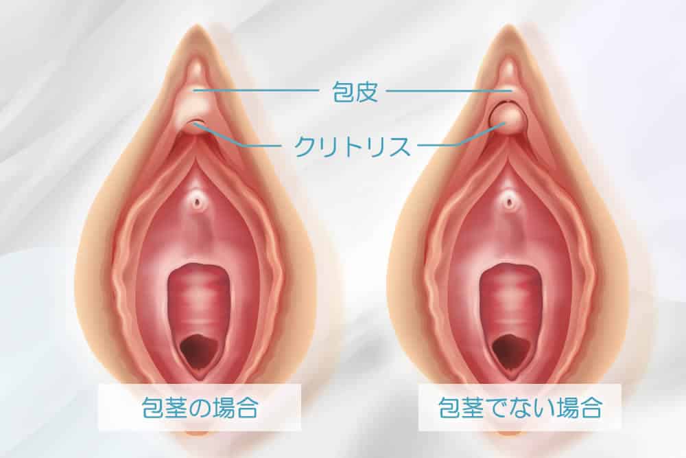 女性のあそこの形、ビラビラ大きさの違い？【医師監修】 - 夜の保健室