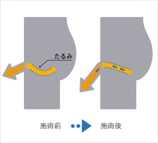 コックリング 仮性 包茎矯正 器具