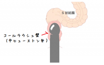 結腸責めについてなのですが、よく言う結腸やS字といわれるのはとは直腸の1番奥の壁で直腸S状部のことだと思います！そこは個人差ありますが20センチくらいのモノは届くそうです。  S状結腸は直腸から直角に曲がった部分ですが開発を続けると曲がった部分も真っ直ぐに入る 