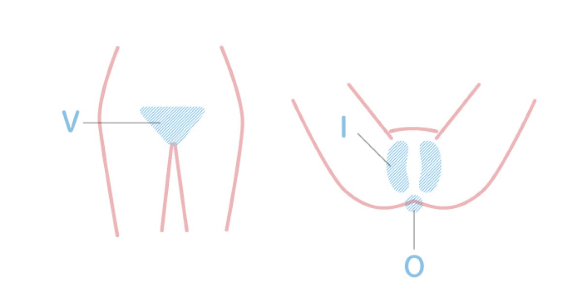 画像付き】男性ウケ抜群！VIO脱毛で人気の形は？Vライン（アンダーヘア）の整え方も紹介 | ミツケル