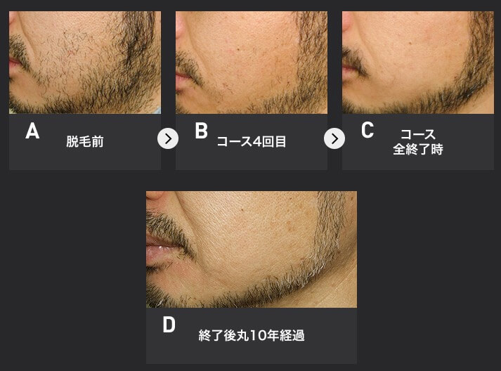 メンズTBCの悪い評判は本当？ニードル脱毛体験で判明した誤解3選 | ヒゲ脱毛ガイド