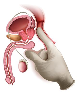 前立腺マッサージを行う医療手袋を持つ泌尿器医。 泌尿器科の男性の性健康のコンセプト。 クリームの潤滑で手がドーナツの穴に指を浸す男性。 婦人科4K前立腺炎機能障害」の動画素材（ロイヤリティフリー）1061696929