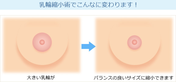 乳輪縮小術 | 豊胸・豊胸手術なら城本クリニック