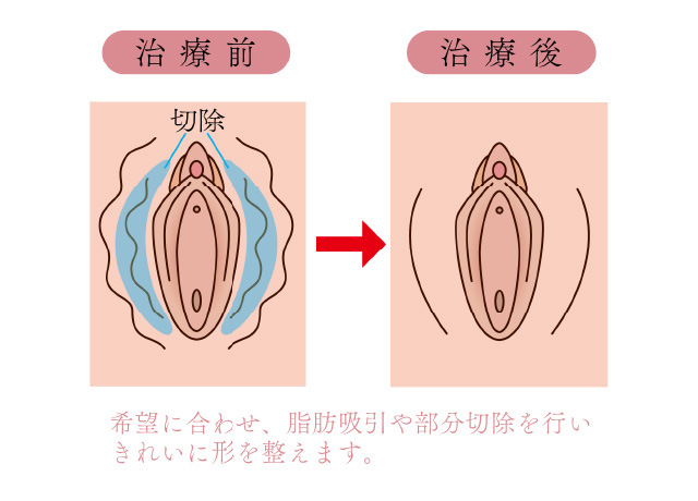 ＧＳＭの腟・外陰所見 - ドクター関口のちょっとセクシーな女子会ブログ