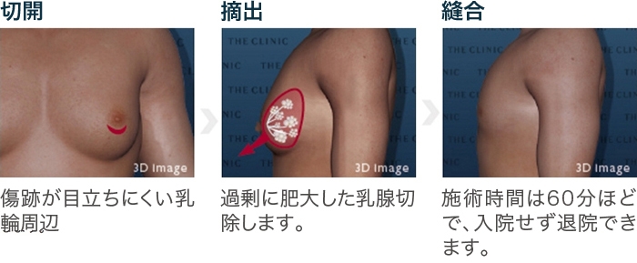 陥没乳頭・陥没乳首を治す方法、他院修正事例紹介とQ&A | 横浜市鶴見の形成・美容外科