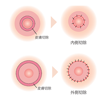 乳輪が大きいのは女性だけの悩み？乳輪の平均サイズと理想の形にするための改善方法をご紹介！！ - 