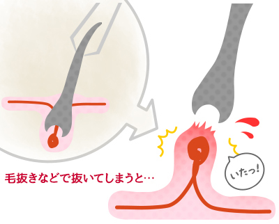 毛を抜く」自己処理はNG！脱毛中にムダ毛をなくす正しい処理方法 | メンズ脱毛百科事典 リンクスペディア