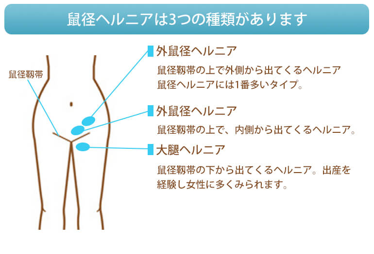 名医に聞く鼠径ヘルニアの手術～外鼠径ヘルニア～ | 鼠径ヘルニア日帰り外科広島アルプスクリニック