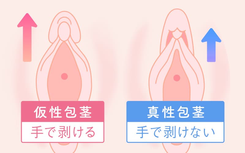 クリトリスが小さい・見つからない！その原因はクリトリス包茎かも…… | シンデレラグループ公式サイト