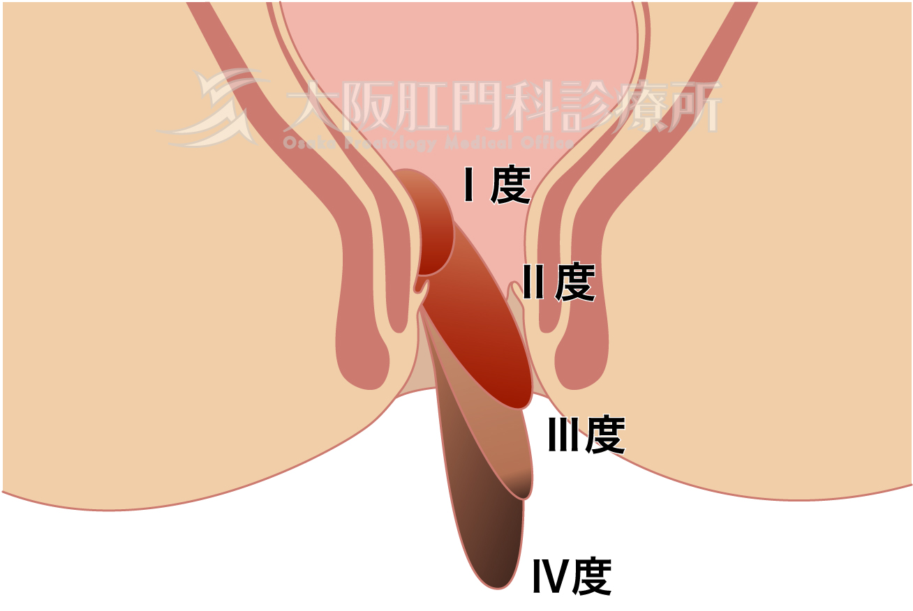 大腸がん検査としては、全く意味の無い直腸診を検診などの流れ作業でなんとなく受けていませんか？ ｜たまプラーザ南口胃腸内科クリニック  消化器内視鏡横浜青葉区院