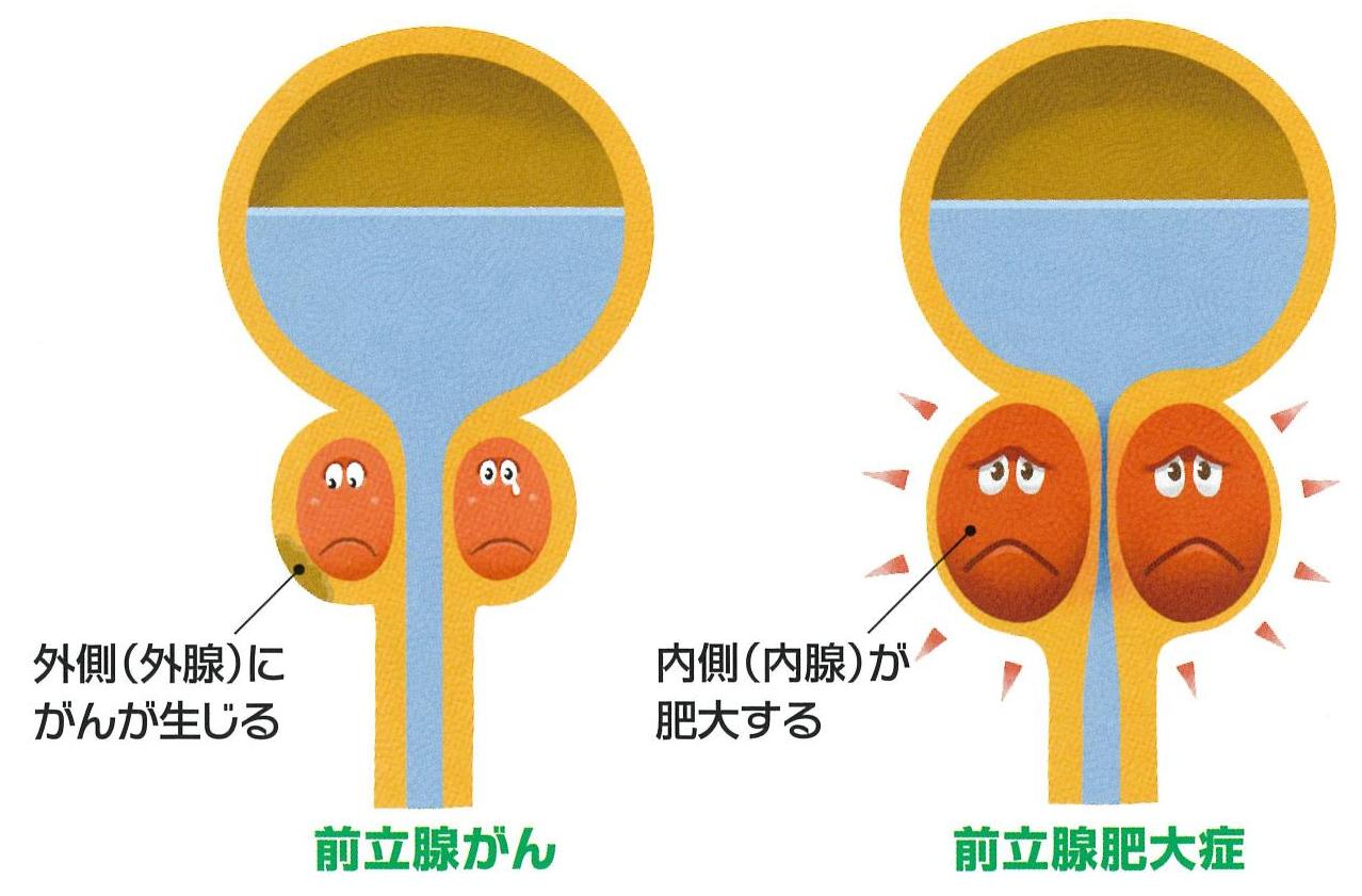 ハイアイランドヘルス - 前立腺マッサージ、前立腺マッサージ、前立腺炎 –