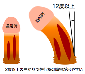 上反りと下反り】ペニスの形によるアナルセックスの快感【ペニスの湾曲の改善】 - エロいアナル大好き！アダルトアブノーマルな出会い