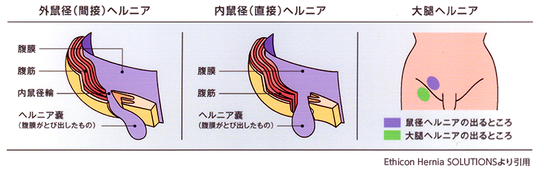 鼠径ヘルニアとは 放置は危険、日帰り手術でも治せる カラダづくり -