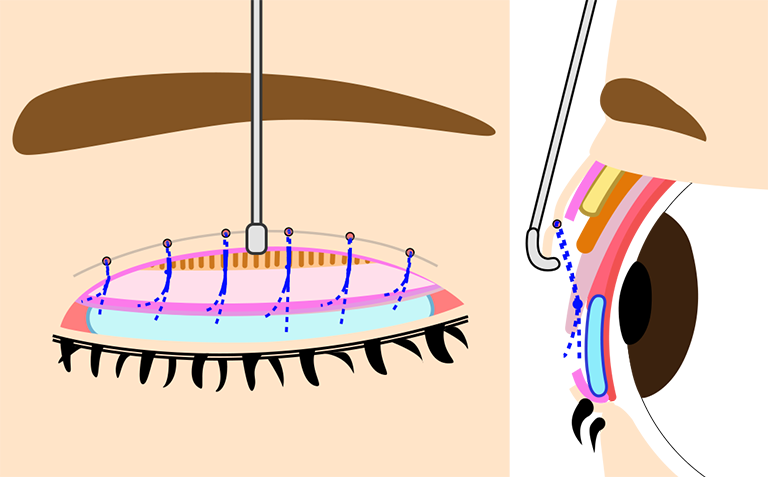 切開した二重を緩める 症例写真｜あつぎ美容クリニック