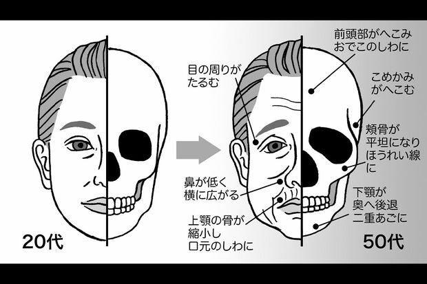 40代男性・切らない二重アゴ治療】輪郭注射（3回後） - 症例写真 -