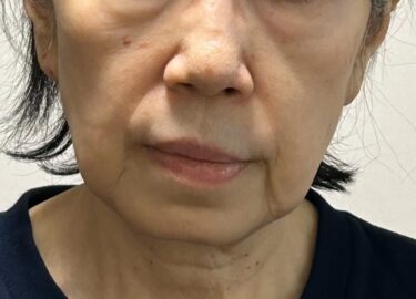 症例写真】額の切開リフトを行った40代男性の症例：美容外科 高須クリニック