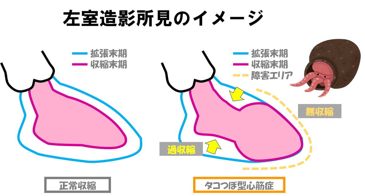 たこつぼ心筋症 | 医療法人社団豊正会