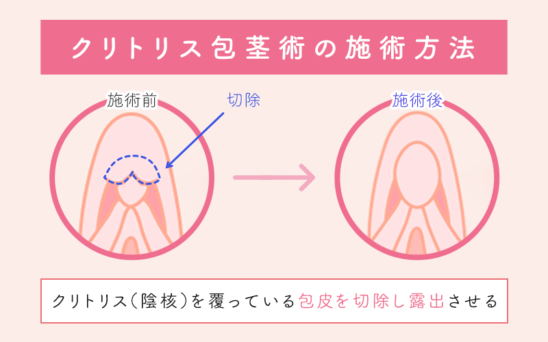 クリトリスの大きさに悩んでいます。 自慰行為の回数の多さも原因だと 思うんですが我慢する事は出来ません…