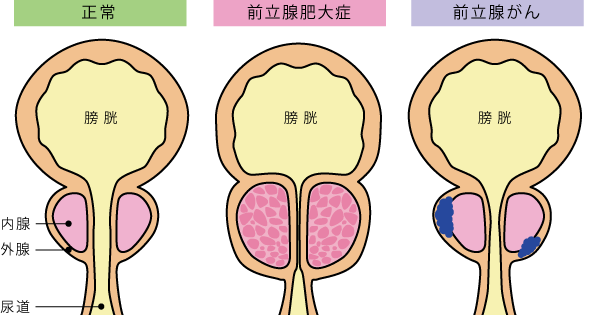 前立腺肥大症 | 杉並区 | 東京都