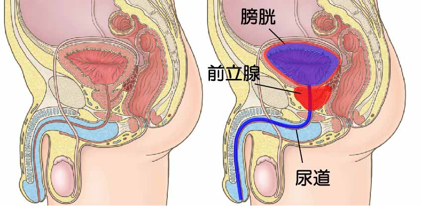 前立腺がん手術後の尿漏れ