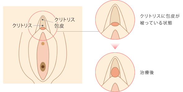 菱形を貫く３本のチューブ - Salon de SM