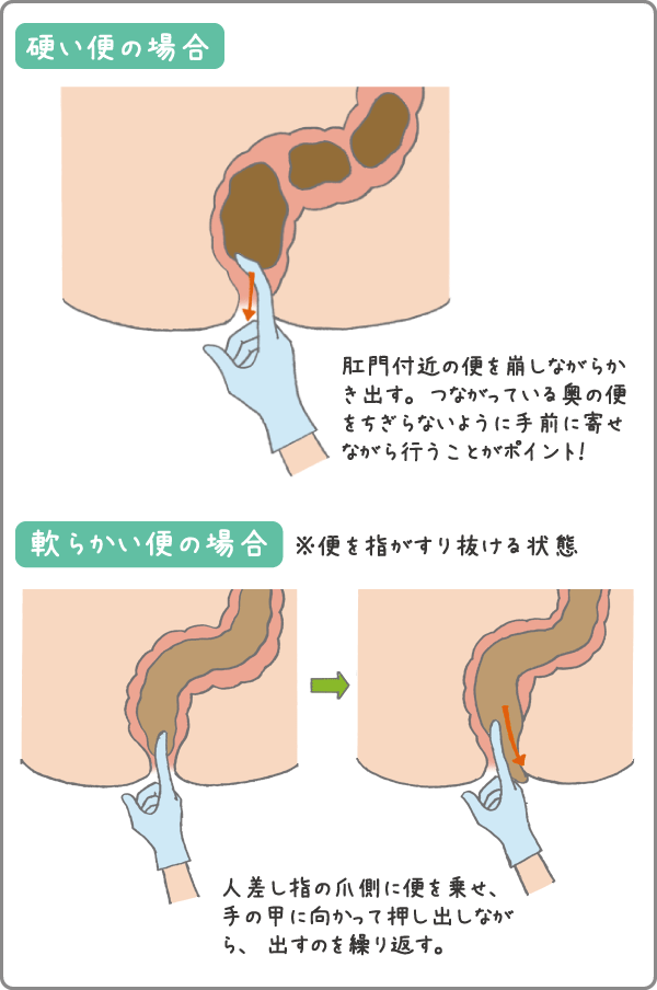 イチジク浣腸40 40g×2個 [第2類医薬品]