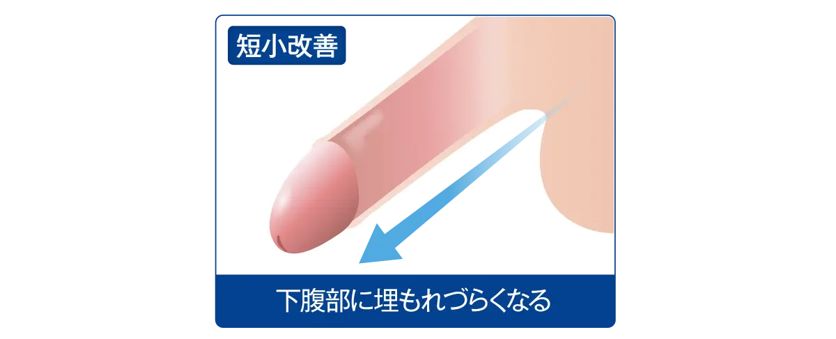 短小包茎の悩み/包茎手術は仙台中央クリニック