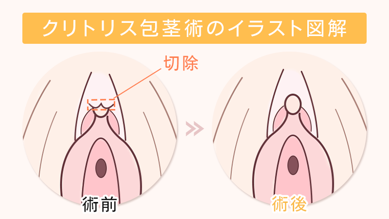 小陰唇縮小術（陰部のびらびら切開）｜婦人科形成をお考えならベリンダクリニック【新宿院・岡山院】