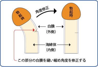 包茎手術 | 種類別の治療法・費用・注意点 | マンモスクリニックグループ