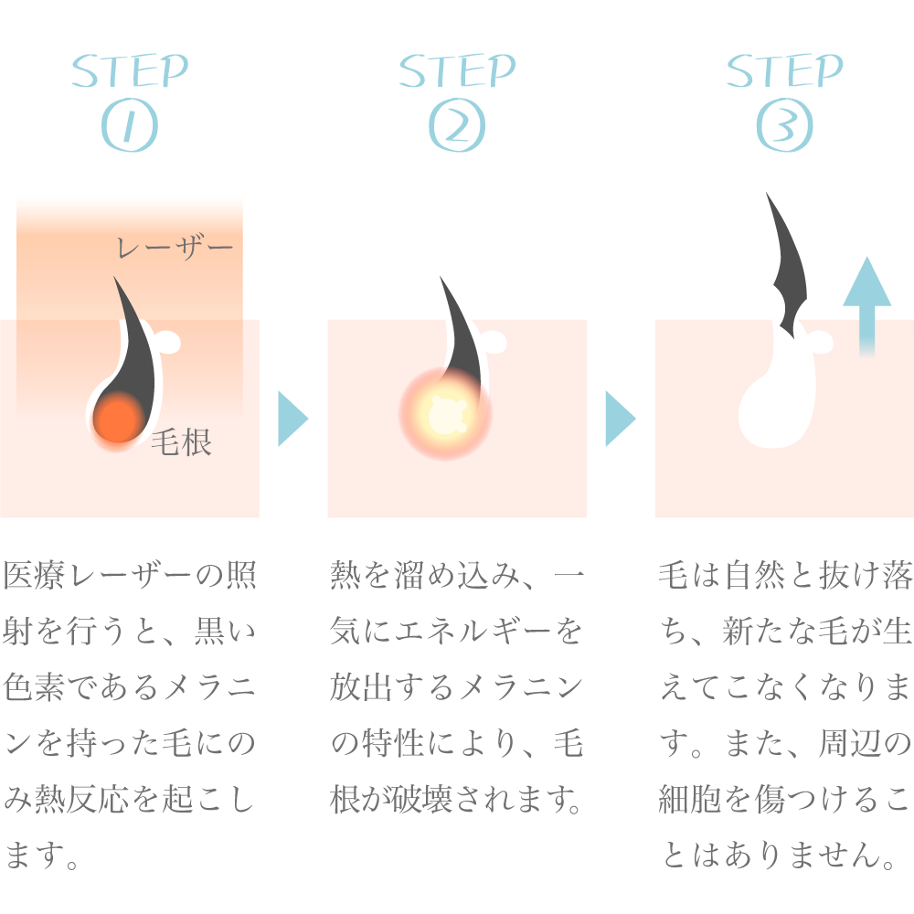 VIO脱毛後の排尿は注意！尿の飛び散りの傾向と対策 - トイトイトイクリニック