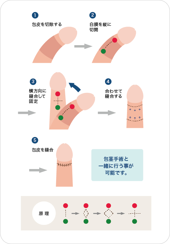 すべての包茎を改善したい方向けグッズ 一覧 | 大人のデパート エムズ