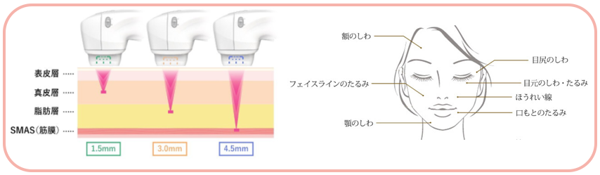 ほうれい線 - 上野御徒町ファラド皮膚科