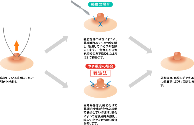 陥没乳頭手術の【他院修正】について｜症例① | 横浜市鶴見の形成・美容外科 エムズクリニック