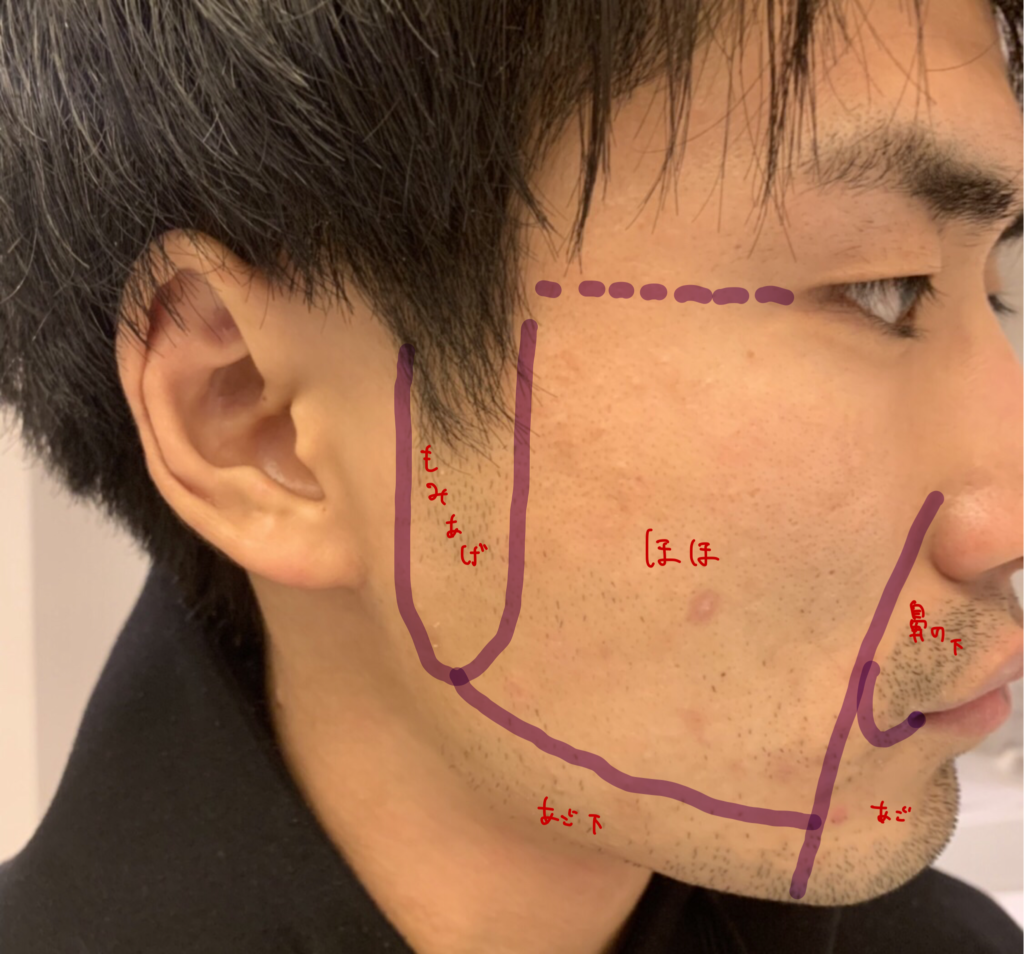 ヒゲを抜き続けると肌がボロボロに！確実にヒゲの悩みを解決する方法 | メンズ脱毛百科事典 リンクスペディア