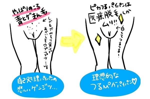 VIO脱毛前の事前処理の注意点と正しい自己処理 - トイトイトイクリニック