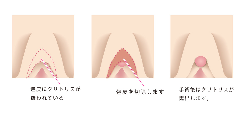 かわいいデリケートゾーン説明画像作ってみましたー関口由紀のブログー | 女性医療クリニックLUNAのBLOG