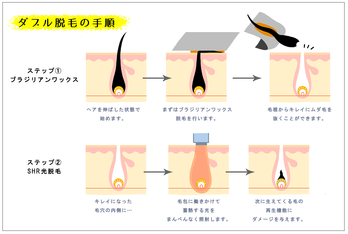 毛抜きはムダ毛処理に向かない？デメリットと時間を無駄にする理由 - 【公式】医療脱毛クレアオム新宿 - メンズ医療脱毛クリニック