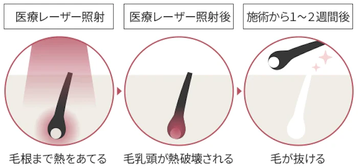 男性が部分脱毛か全身脱毛か迷った時の決め方 ｜メンズ脱毛【NAX】