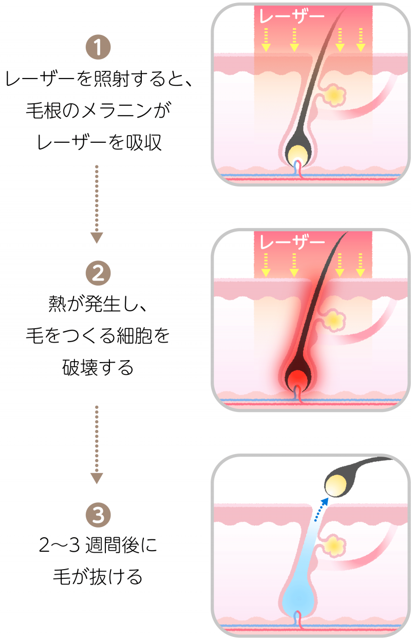 VIO脱毛はするべき？メリット、デメリットと施術のポイントを解説｜脱毛・ダイエットなら美容ナビ｜アイメッド