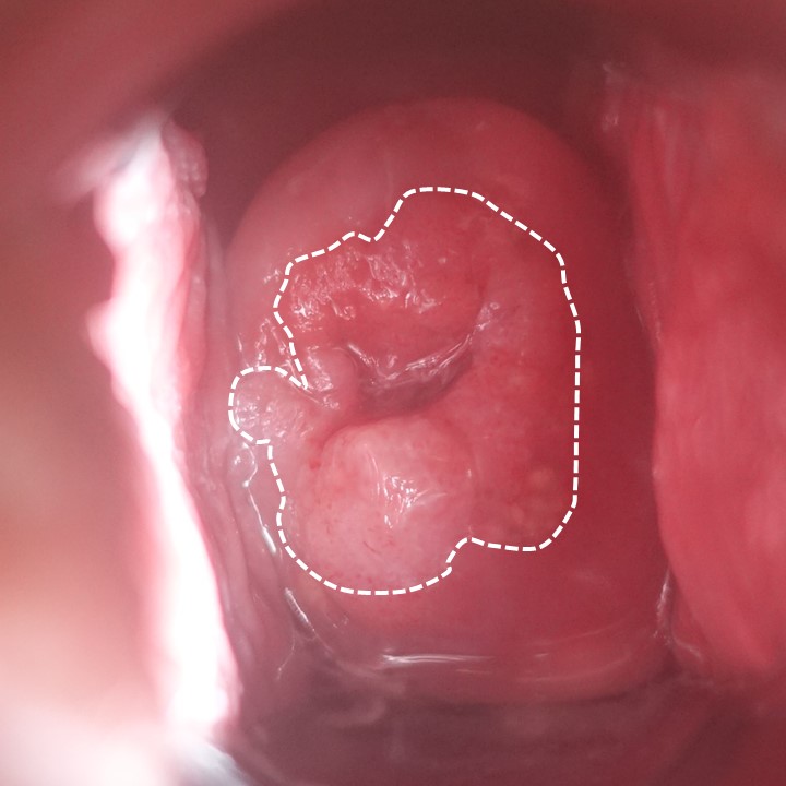 性器だけでなく、喉にも注意】ピンサロで感染する可能性のある性病とは│セイシラ