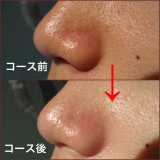 決定版】体験1回で効果あり！お肌の乾燥・カサつきに効果的なフェイシャルエステを徹底比較！ | SlimMagazine