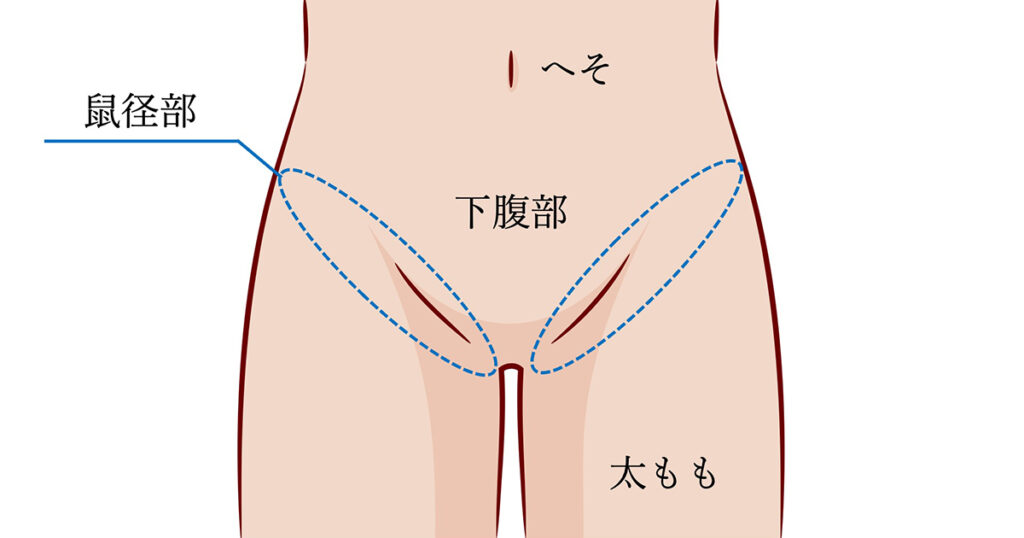 富士見市・ふじみ野市で鼠径ヘルニアの日帰り手術なら根本外科整形外科