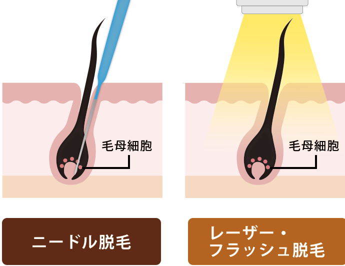 髭を抜くと生えなくなる?毛抜きのデメリットやおすすめのメンズ脱毛を紹介