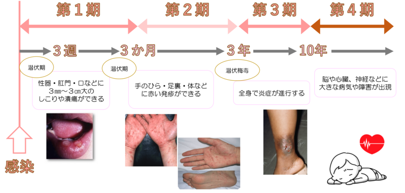 クンニで喉が痛い！】性病？扁桃腺炎？咽頭クラミジアと咽頭淋菌の可能性・大！ – サコダ・レディースクリニック