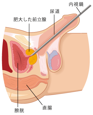 前立腺の病気 - ふじもと医院